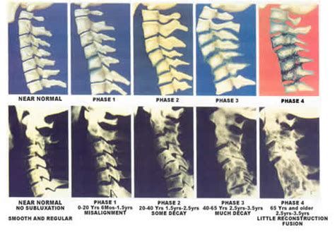 Subluxation The Chiropractic Cavity Core Chiropractic