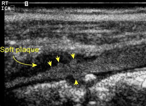 Sonographic Examination Of The Carotid Arteries Radiographics