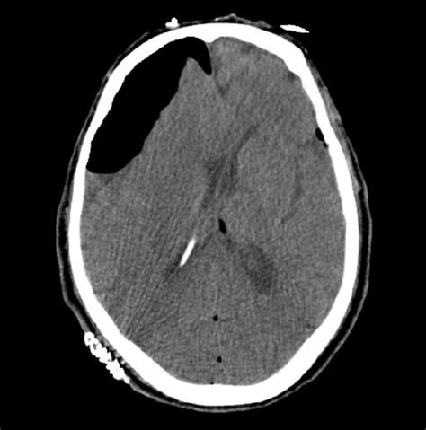 Tension Pneumocephalus Following Ventriculoperitoneal Shunt Insertion