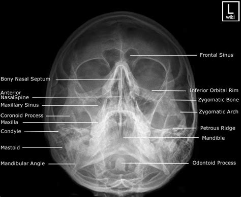 facial bones radiographic anatomy wikiradiography facial bones