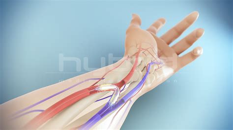 Arteriovenous (AV) Fistula | Hybrid Medical Animation