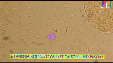 Entamoeba Histolytica Cyst In Stool Treatment Decoration Dinterieur ...