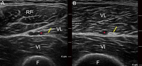 Pain Relief After Total Knee Arthroplasty With Vastus Lateralis Nerve