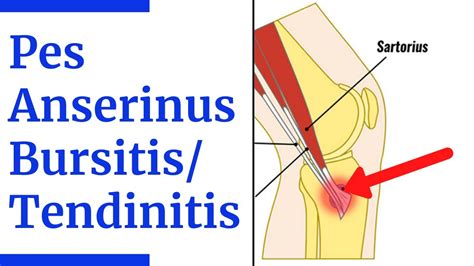 Pes Anserine Bursitis, Pes Anserine Syndrome, Lower, 57% OFF