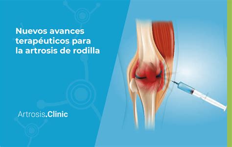 Nuevos Tratamientos Para El Dolor De Artrosis De Rodilla Regeneractiva