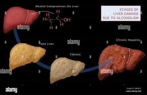 Fibrosis Hepática Fotos e Imágenes de stock Página 2 Alamy