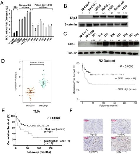 Skp2 Is Overexpressed In Osteosarcoma Cell Lines And High Skp2 Levels