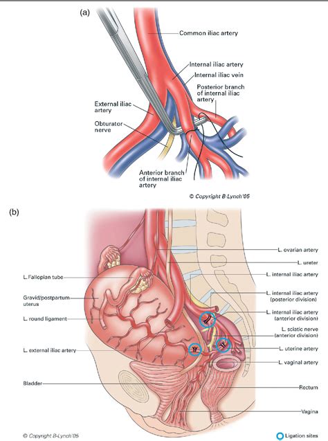 Figure 1 From Internal Iliac Hypogastric Artery Ligation Semantic