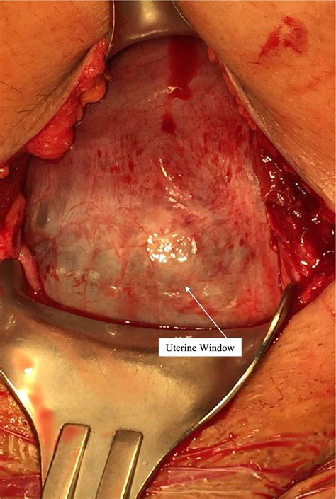 “Uterine Dehiscence: A Diagnostic Conundrum in Repeat Cesarean