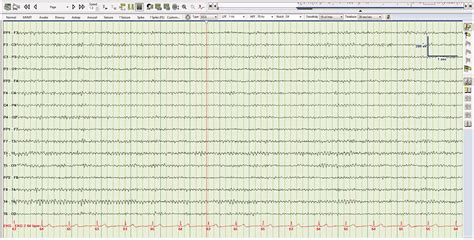 Electroencephalogram Patterns In Critical Care A Primer For Acute Care