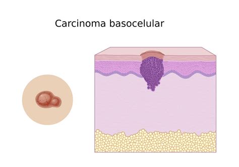 O Que é O Carcinoma Basocelular Cursau Educação Blog