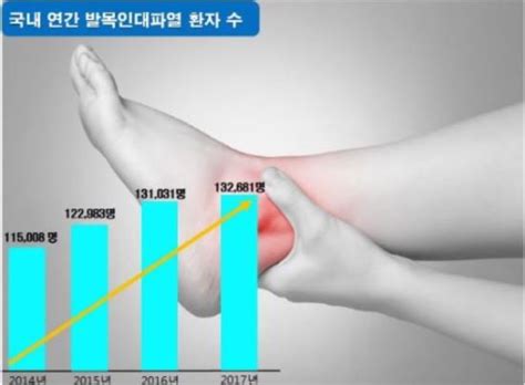 삐끗한 발목 통증 사라져도 발목보호대 2~3주 착용해야 국민일보