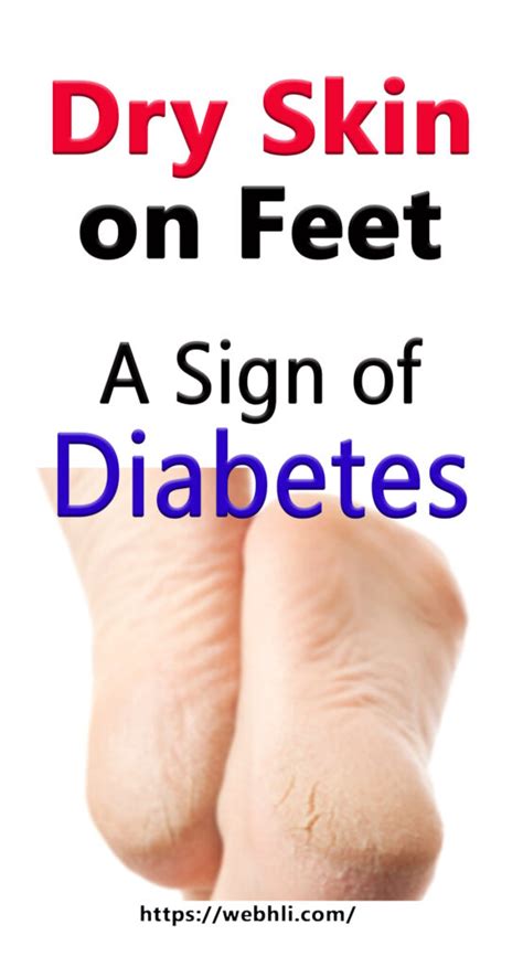 Dry Skin on Feet – A Sign of Diabetes | Healthy Lifestyle