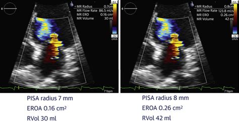 Basic Principles Of The Echocardiographic Evaluation Of Mitral