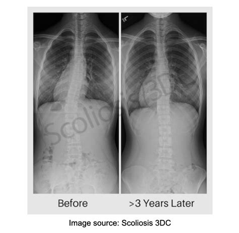 Scoliosis X Ray Before And After