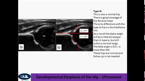 Developmental Dysplasia Of The Hip Ultrasound