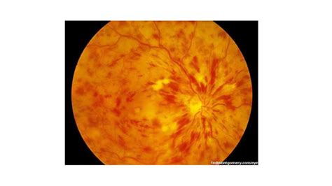 Retinal Detachment Causes & Treatment