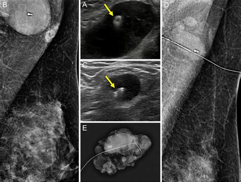 A 37 Year Old Woman With Left Breast Cancer And Ipsilateral Axillary Download Scientific