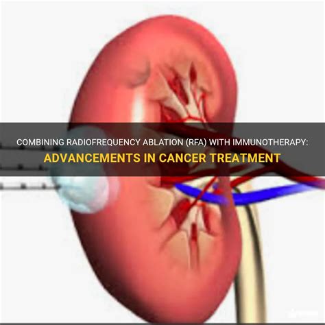 Combining Radiofrequency Ablation Rfa With Immunotherapy