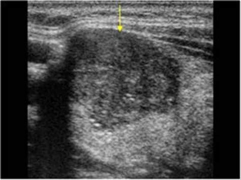 Papillary Thyroid Cancer Ultrasound