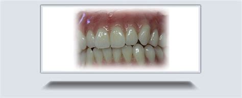 Bps Dentures Hamilton Precision Dentures Waterdown Denture Clinic