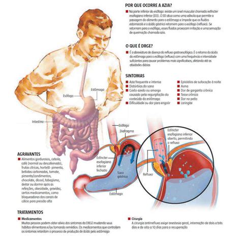 Reeducação alimentar é saída para resolver o refluxo gastroesofágico