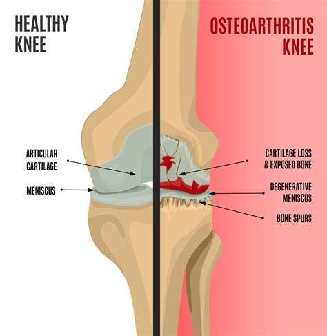 Common Types Of Arthritis That Affect The Knee – cyriaxphysio