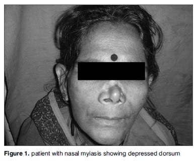 Nasal Myiasis