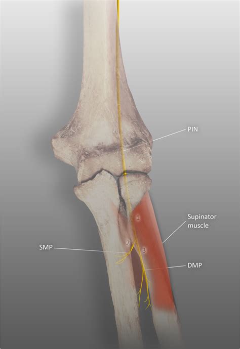 Three Types Of The Proximal Posterior Interosseous Nerve Palsy PIN