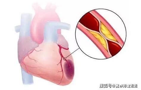 心梗发生前，一般会出现6种迹象，若一个没有，说明血管还算健康 搜狐大视野 搜狐新闻