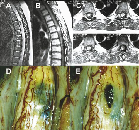 Spinal Vascular Malformations Neupsy Key