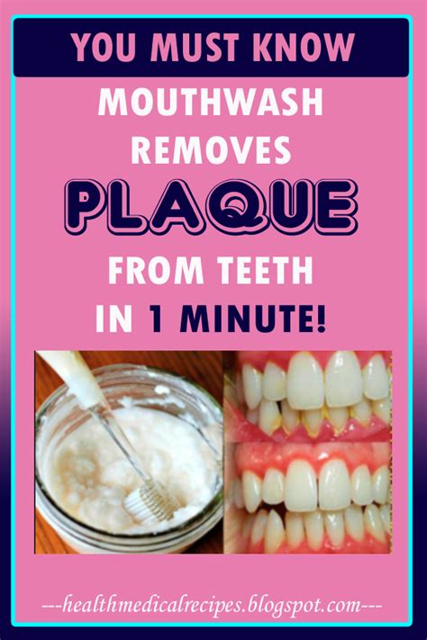 Mouthwash Removes Plaque From Teeth In 1 Minute