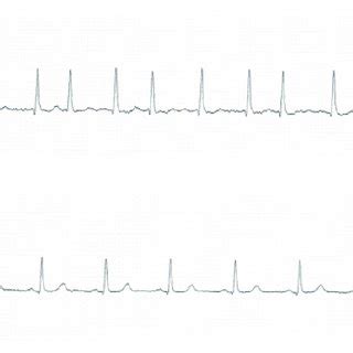 Nitial Electrocardiogram Showing Atrial Fibrillation Superior And In