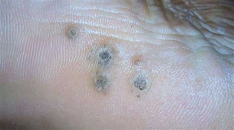 Planters Wart On Hand Removal | Bruin Blog