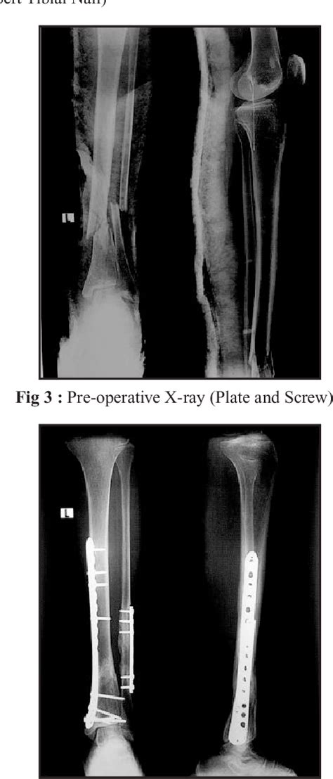 Figure From Extra Articular Proximal And Distal Metaphyseal Tibial