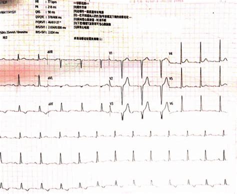 ECG Showing A Deepened Q Wave With Resolution Of ST Segment Elevation