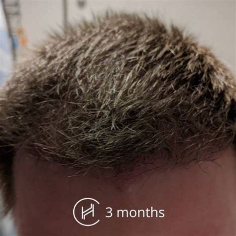 35+ Fue Hair Transplant Recovery Timeline - FergusAshley