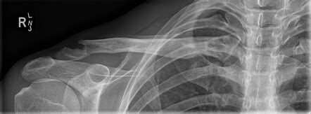 Rhomboid fossa of the clavicle | Radiology Reference Article ...