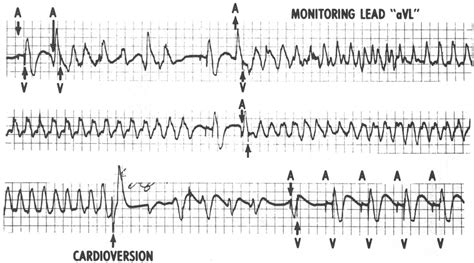 Figure 3 From Ventricular Tachycardia Produced By A Normally Functioning Av Sequential Demand