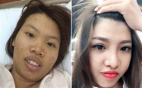 Vietnamese Plastic Surgery Before And After