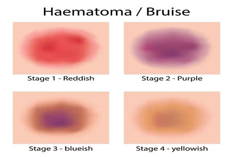 Bruise Diagram Bruise Diagram