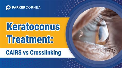 Cairs Vs Crosslinking Keratoconus Treatment Youtube