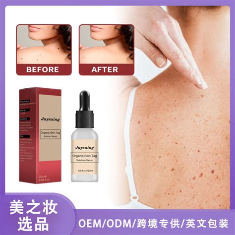 Mole Potion Mole Removal Cream Repair Mole Removal Black Spot Mole ...