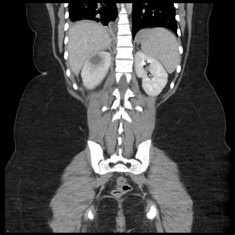 Renal Abscess Image