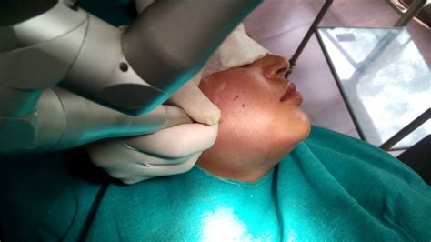 Mole Removal Treatment Skin Laser Centre Youtube