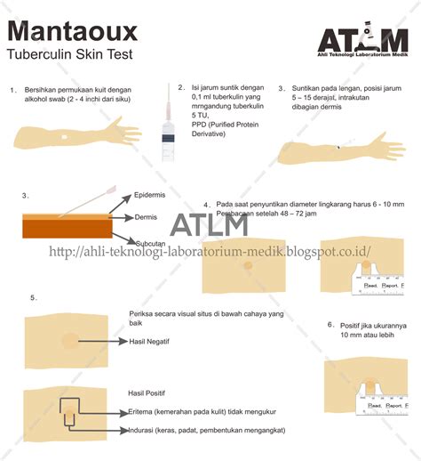 Pemeriksaan Mantoux Test Tuberculin Skin Test — Atlm