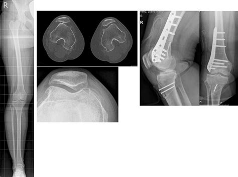 Year Old Female Patient With Recurrent Patellar Dislocations Right