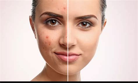 Acne tips for managing – Artofit