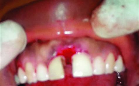 Surgical Site After Complete Excision Of The Fibrous Epulis Download