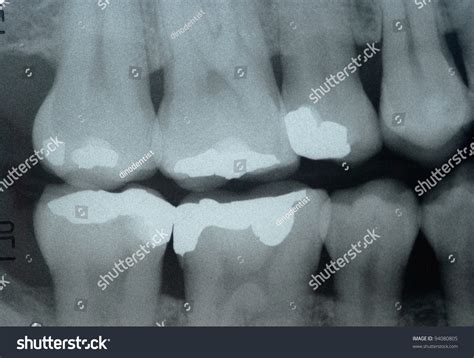 Dental X Ray Bite Wing Technic For Check Dental Caries Stock Photo